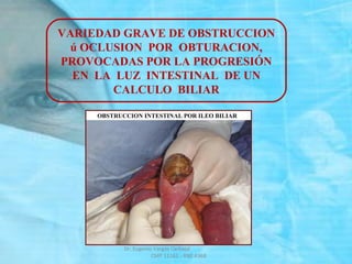 VARIEDAD GRAVE DE OBSTRUCCION
ú OCLUSION POR OBTURACION,
PROVOCADAS POR LA PROGRESIÓN
EN LA LUZ INTESTINAL DE UN
CALCULO BILIAR
Dr. Eugenio Vargas Carbajal
CMP 11161 - RNE 4368
 
