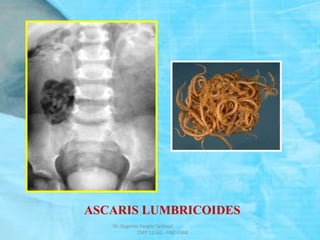 ASCARIS LUMBRICOIDES
Dr. Eugenio Vargas Carbajal
CMP 11161 - RNE 4368
 