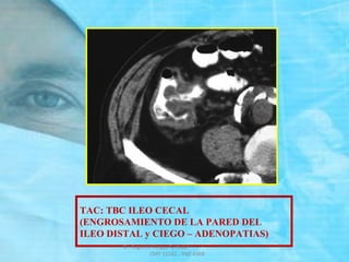TAC: TBC ILEO CECAL
(ENGROSAMIENTO DE LA PARED DEL
ILEO DISTAL y CIEGO – ADENOPATIAS)
Dr. Eugenio Vargas Carbajal
CMP 11161 - RNE 4368
 