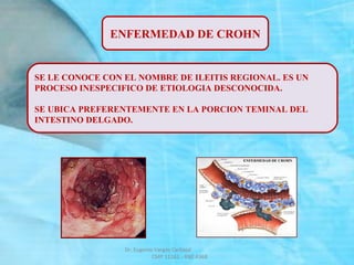 ENFERMEDAD DE CROHN
SE LE CONOCE CON EL NOMBRE DE ILEITIS REGIONAL. ES UN
PROCESO INESPECIFICO DE ETIOLOGIA DESCONOCIDA.
SE UBICA PREFERENTEMENTE EN LA PORCION TEMINAL DEL
INTESTINO DELGADO.
Dr. Eugenio Vargas Carbajal
CMP 11161 - RNE 4368
 