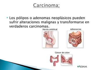    Los pólipos o adenomas neoplásicos pueden
    sufrir alteraciones malignas y transformarse en
    verdaderos carcinomas.
 