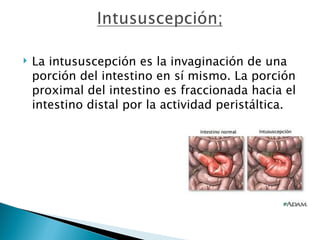    La intususcepción es la invaginación de una
    porción del intestino en sí mismo. La porción
    proximal del intestino es fraccionada hacia el
    intestino distal por la actividad peristáltica.
 