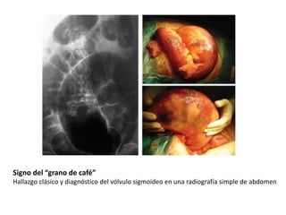 Signo del “grano de café”
Hallazgo clásico y diagnóstico del vólvulo sigmoideo en una radiografía simple de abdomen
 