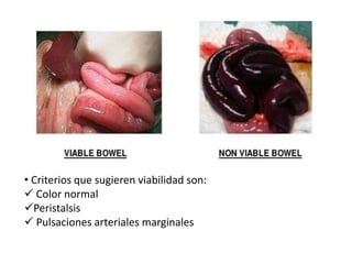 • Criterios que sugieren viabilidad son:
 Color normal
Peristalsis
 Pulsaciones arteriales marginales
 
