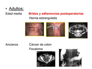 • Adultos:
Edad media Bridas y adherencias postoperatorias
Hernia estrangulada
Ancianos Cáncer de colon
Fecaloma
 