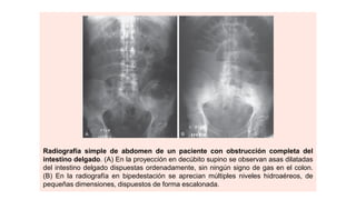 Radiografía simple de abdomen de un paciente con obstrucción completa del
intestino delgado. (A) En la proyección en decúbito supino se observan asas dilatadas
del intestino delgado dispuestas ordenadamente, sin ningún signo de gas en el colon.
(B) En la radiografía en bipedestación se aprecian múltiples niveles hidroaéreos, de
pequeñas dimensiones, dispuestos de forma escalonada.
 