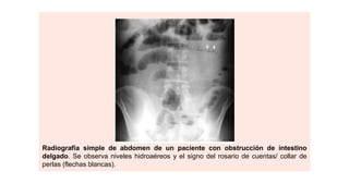 Radiografía simple de abdomen de un paciente con obstrucción de intestino
delgado. Se observa niveles hidroaéreos y el signo del rosario de cuentas/ collar de
perlas (flechas blancas).
 