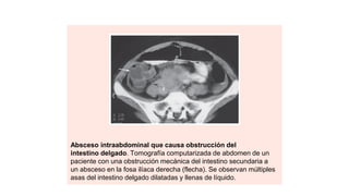 Absceso intraabdominal que causa obstrucción del
intestino delgado. Tomografía computarizada de abdomen de un
paciente con una obstrucción mecánica del intestino secundaria a
un absceso en la fosa ilíaca derecha (flecha). Se observan múltiples
asas del intestino delgado dilatadas y llenas de líquido.
 