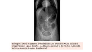 Radiografía simple de abdomen en bipedestación, de proyección AP, se observa la
imagen típica en «grano de café», con dilatación significativa del intestino involucrado,
así como ausencia de gas en ámpula rectal.
 