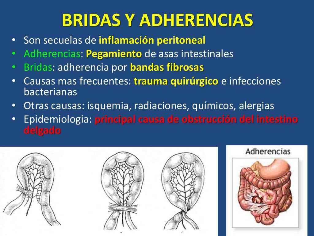 Obstruccion Intestinal