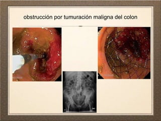 obstrucción por tumuración maligna del colon
 