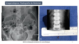Abc Radiografía obstrucción intestinal una nueva perspectiva rr.pptx