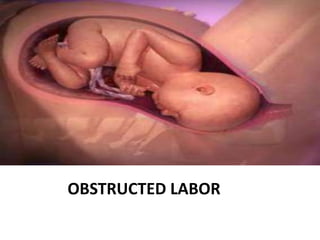 OBSTRUCTED LABOR
 