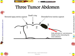 Three Tumor Abdomen
13
Fully distended or/ and edematous
bladder further distending the
lower abdomen
1
1 2
3
Obstructed Labor - By Dr Gebresilassie
Andualem
 