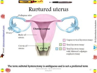 Ruptured uterus
• Destructive vaginal operation is a contraindicated
• Laparotomy ➔
– Total hysterectomy
• Extensive tear
• Necrotic edges
• Tears difficult to stitch such as posterior tears and extension into the vagina
• Grossly infected uterus
• Rupture after prolonged labor
• Future cervical cancer concern
– Subtotal hysterectomy
• Similar conditions as total hysterectomy that are related to infection and tear
• Relative ease of procedure than total hysterectomy
• High subtotal hysterectomy preserves menstruation
• May also preserve sexual pleasure
22
The term subtotal hysterectomy is ambiguous and is not a preferred term
Uterine corpus
Cervix
Obstructed Labor - By Dr Gebresilassie
Andualem
 