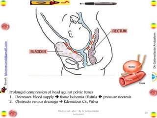 29
Prolonged compression of head against pelvic bones
1. Decreases blood supply ➔ tissue Ischemia (Fistula  pressure necrosis
2. Obstructs venous drainage → Edematous Cx, Vulva
Obstructed Labor - By Dr Gebresilassie
Andualem
 