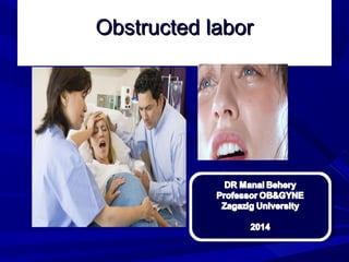 Obstructed laborObstructed labor
 