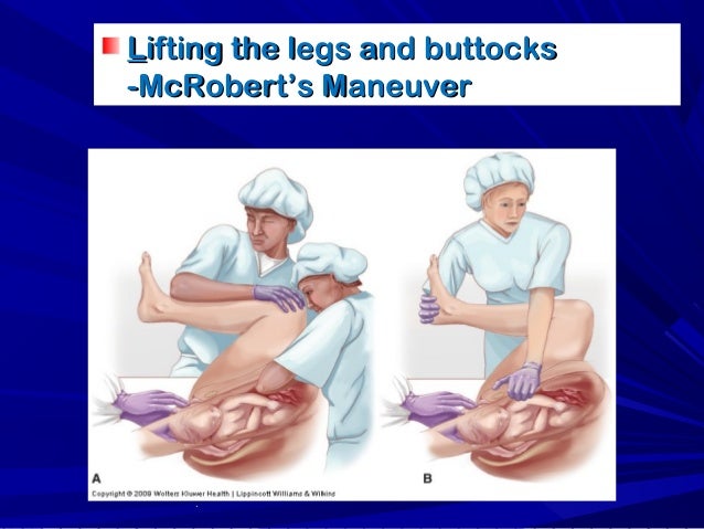 Obstructed labor and shoulder dystocia for undergraduate