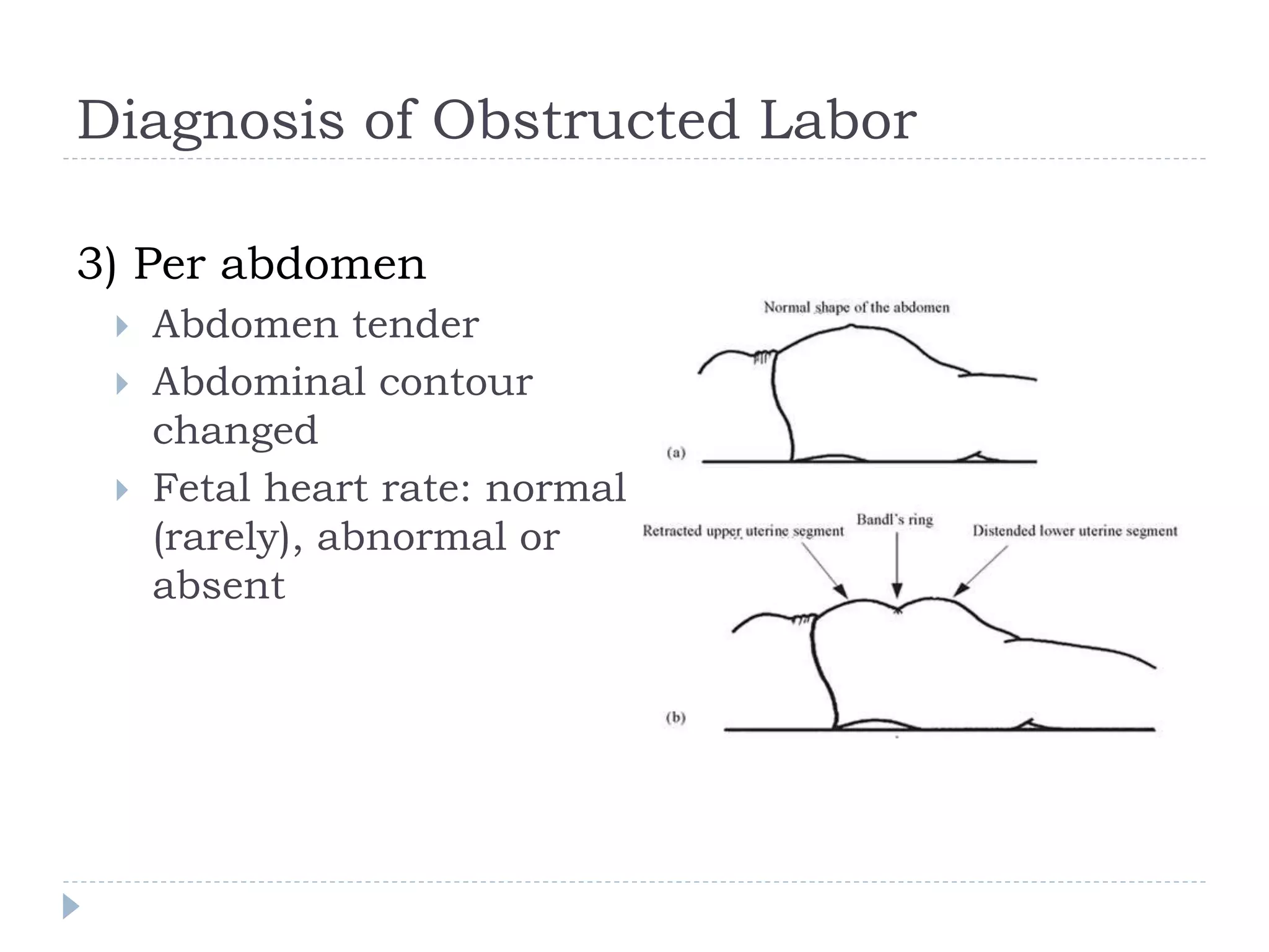 Obstructed labor and uterine rupture | PPTX