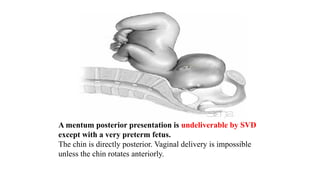 A mentum posterior presentation is undeliverable by SVD
except with a very preterm fetus.
The chin is directly posterior. Vaginal delivery is impossible
unless the chin rotates anteriorly.
 