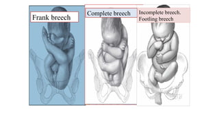 Frank breech
Complete breech Incomplete breech.
Footling breech
 