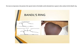 The transverse depression at the junction of the superior border of the bladder and the distended lower segment is often confused with the Bandl’s ring.
 