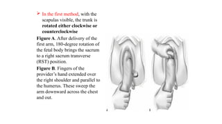  In the first method, with the
scapulas visible, the trunk is
rotated either clockwise or
counterclockwise
Figure A. After delivery of the
first arm, 180-degree rotation of
the fetal body brings the sacrum
to a right sacrum transverse
(RST) position.
Figure B. Fingers of the
provider’s hand extended over
the right shoulder and parallel to
the humerus. These sweep the
arm downward across the chest
and out.
 
