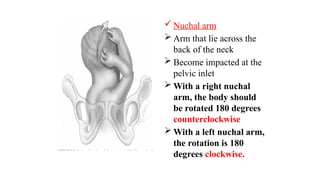  Nuchal arm
 Arm that lie across the
back of the neck
 Become impacted at the
pelvic inlet
 With a right nuchal
arm, the body should
be rotated 180 degrees
counterclockwise
 With a left nuchal arm,
the rotation is 180
degrees clockwise.
 