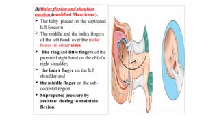 B)Malar flexion and shoulder
traction (modified Mauriceau).
 The baby placed on the supinated
left forearm
 The middle and the index fingers
of the left hand over the malar
bones on either sides
 The ring and little fingers of the
pronated right hand on the child’s
right shoulder,
 the index finger on the left
shoulder and
 the middle finger on the sub-
occipital region.
 Suprapubic pressure by
assistant during to maintain
flexion.
 