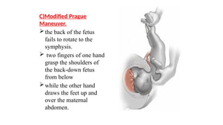 C)Modified Prague
Maneuver.
the back of the fetus
fails to rotate to the
symphysis.
 two fingers of one hand
grasp the shoulders of
the back-down fetus
from below
while the other hand
draws the feet up and
over the maternal
abdomen.
 