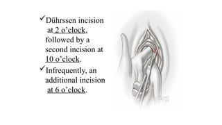 Dührssen incision
at 2 o’clock,
followed by a
second incision at
10 o’clock.
Infrequently, an
additional incision
at 6 o’clock.
 