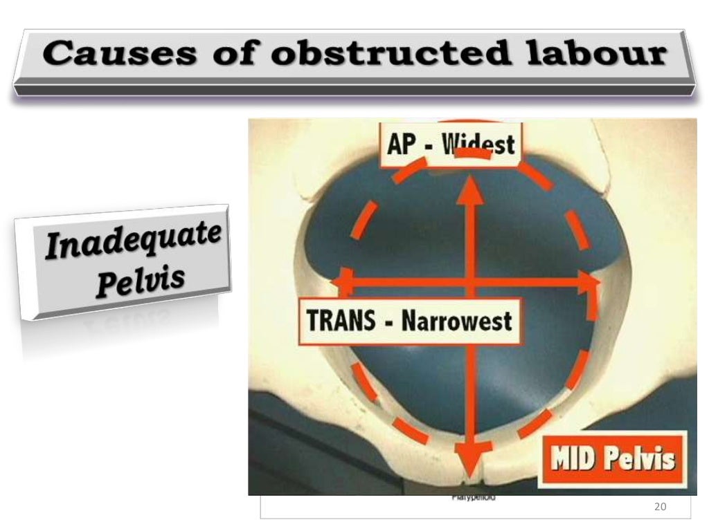 Obstructed Labour