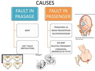 CAUSES
FAULT IN
PAASAGE
BONY
SOFT TISSUE
OBSTRUCTIONS
FAULT IN
PASSENGER
TRANSVERSE LIE
BROW PRESENTATION
OCCIPITOPOSTERIOR
BIG BABY
MULTIPLE PREGNANCY
CONGENITAL
ANOMALIES OF FETUS
 