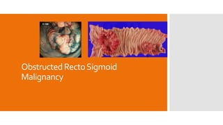 ObstructedRectoSigmoid
Malignancy
 