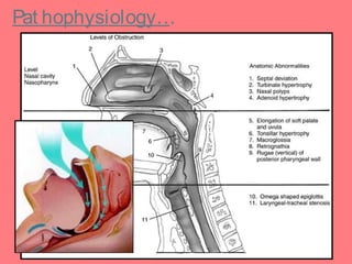 Sleep Apnea Diagram Labeled