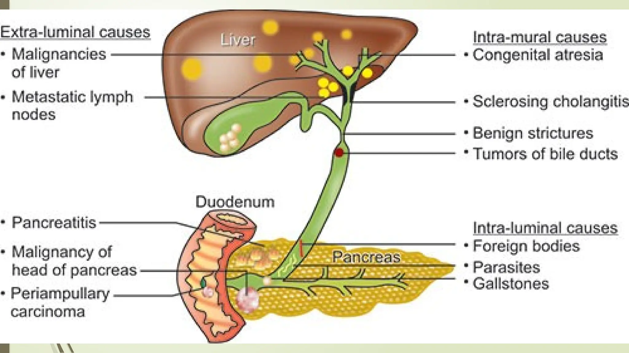 Obstructive Meaning Obstructive Biliopathy.pptx .ppt on obstructive biliopathy | PPT