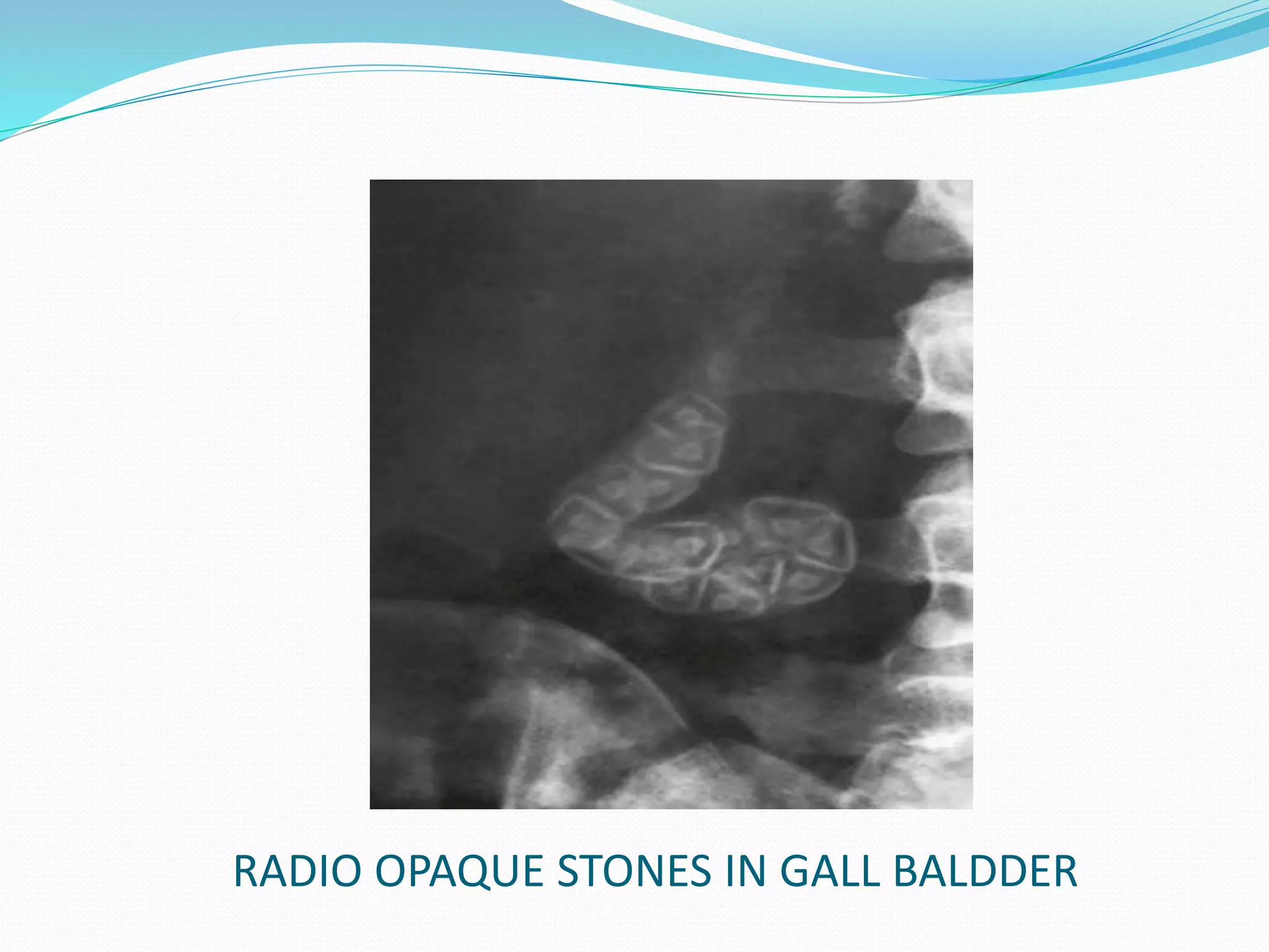 RADIO OPAQUE STONES IN GALL BALDDER
 