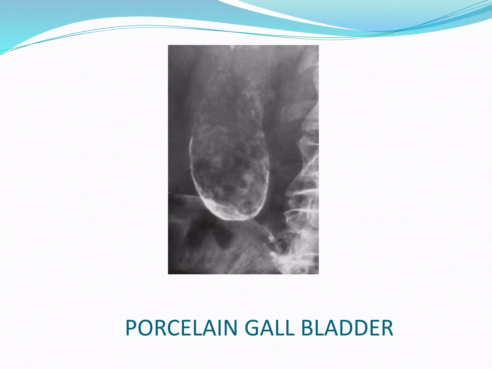 PORCELAIN GALL BLADDER
 