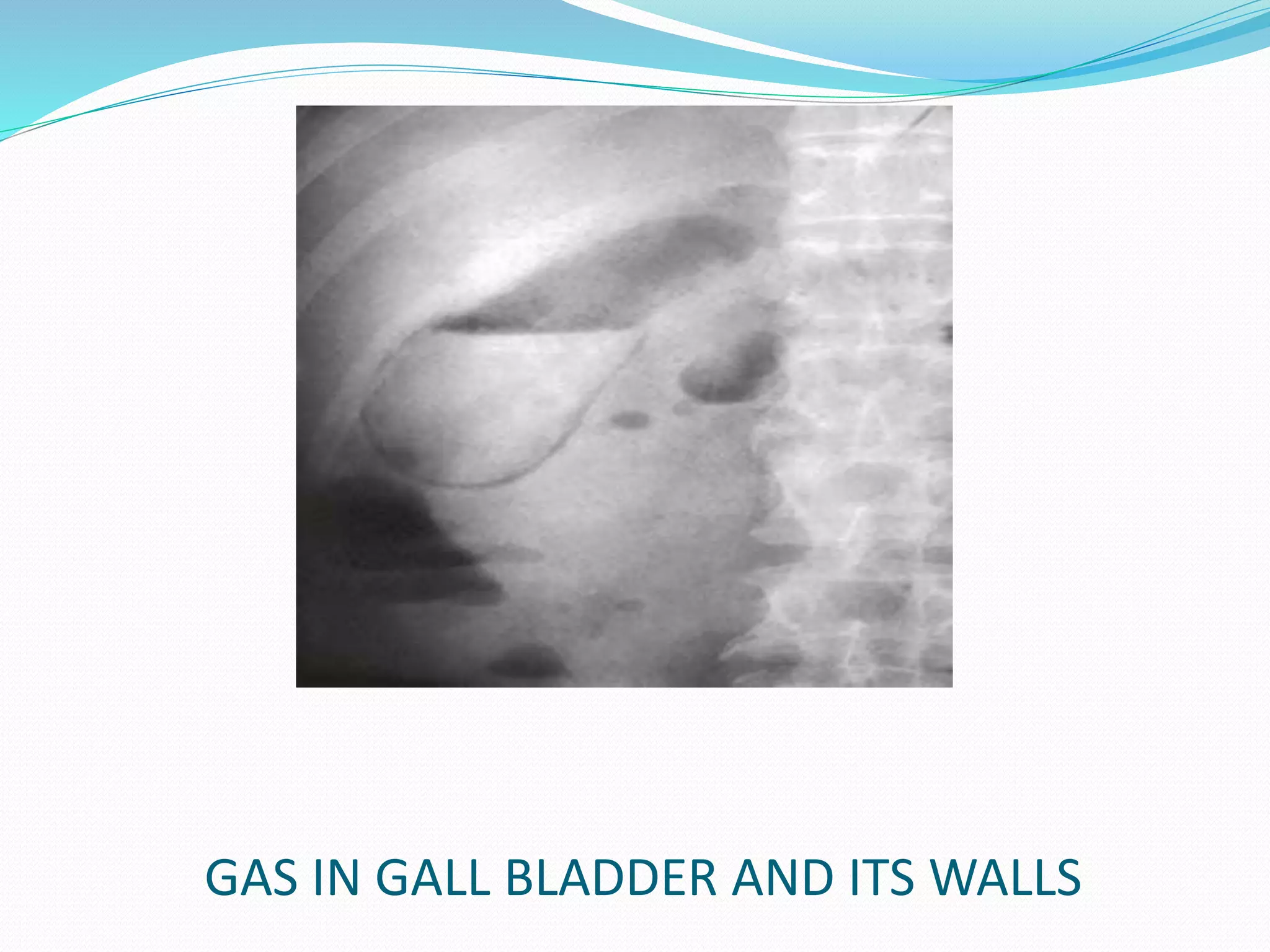 GAS IN GALL BLADDER AND ITS WALLS
 