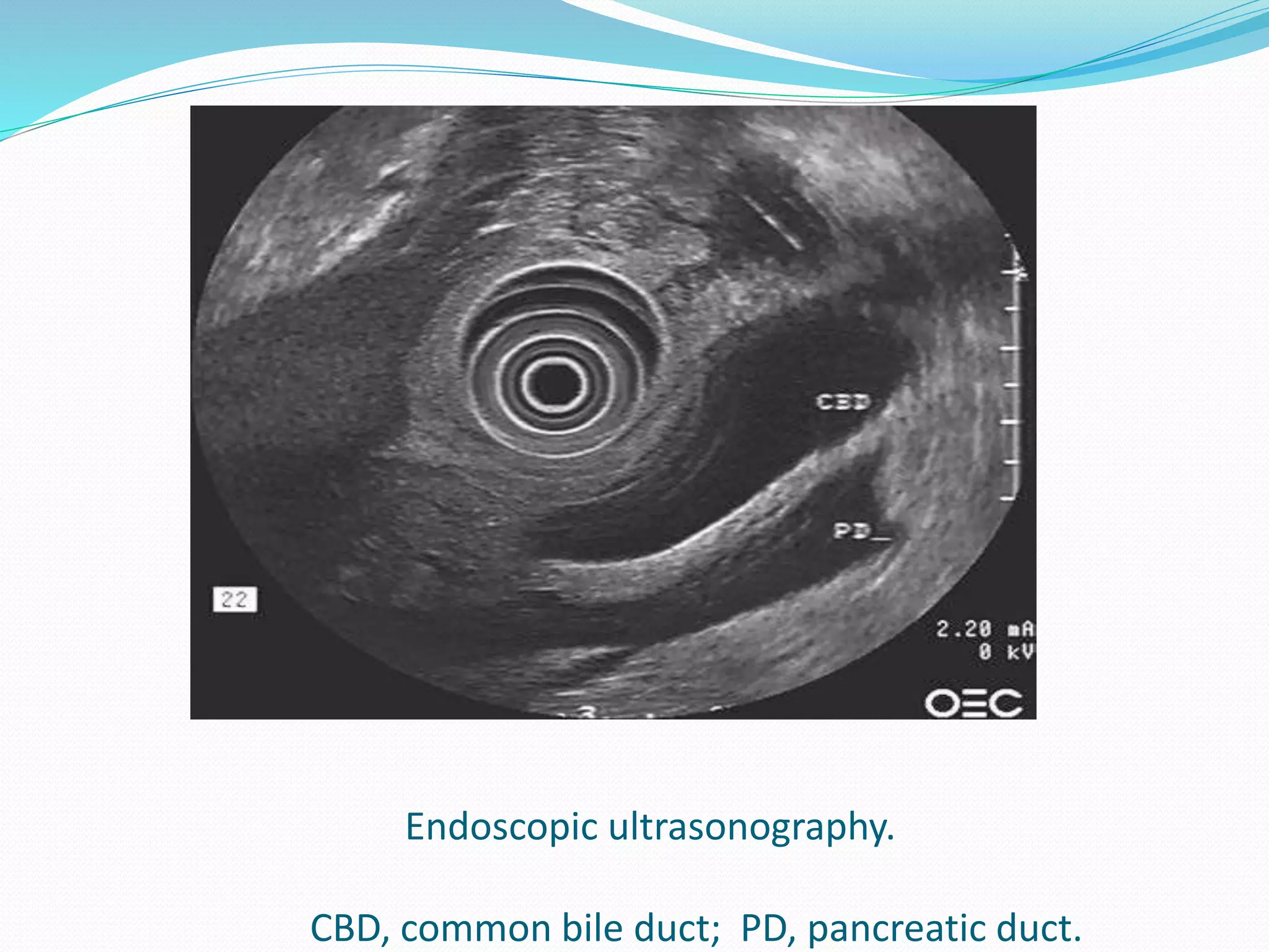 Endoscopic ultrasonography.
CBD, common bile duct; PD, pancreatic duct.
 