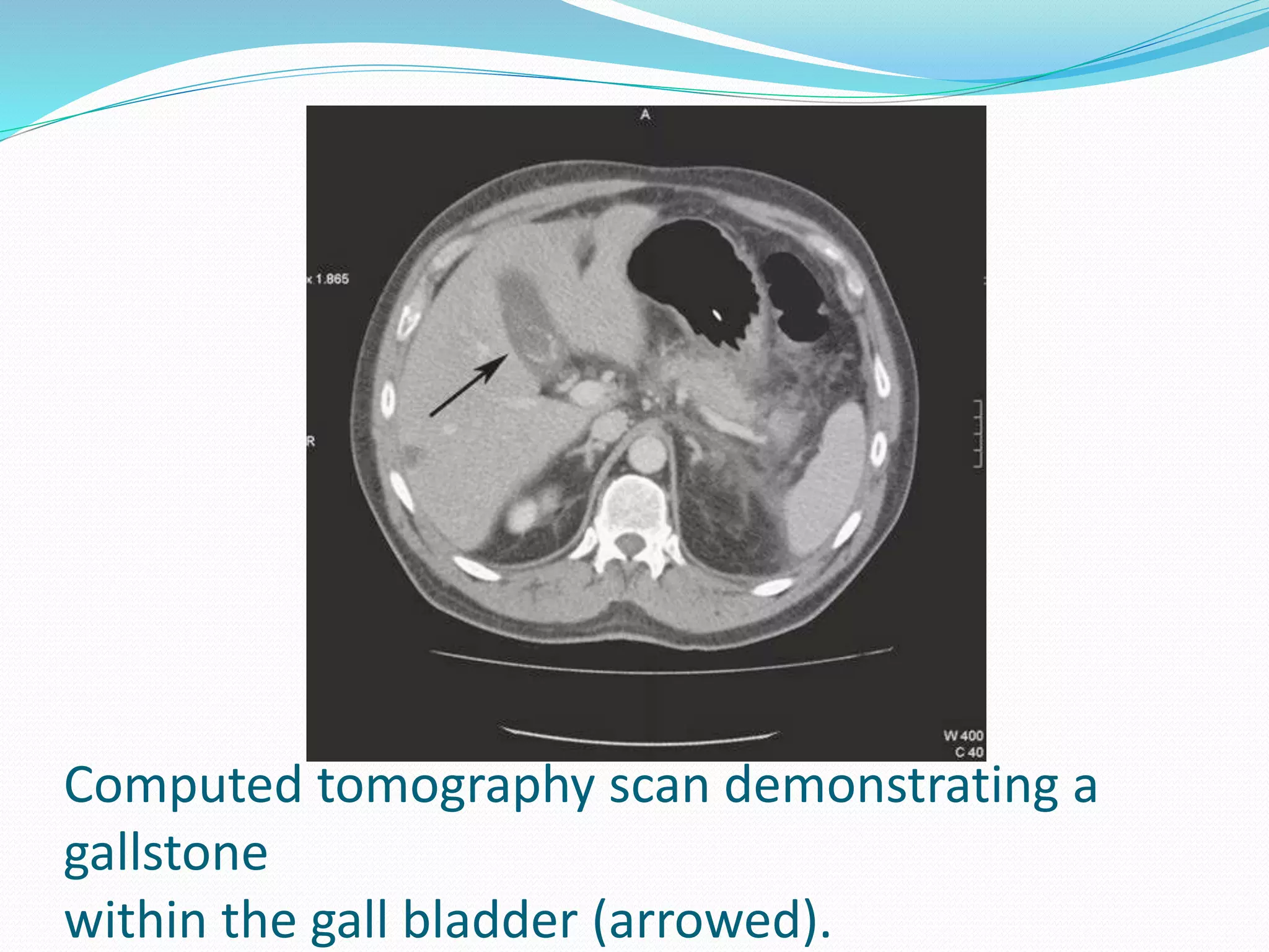 Computed tomography scan demonstrating a
gallstone
within the gall bladder (arrowed).
 