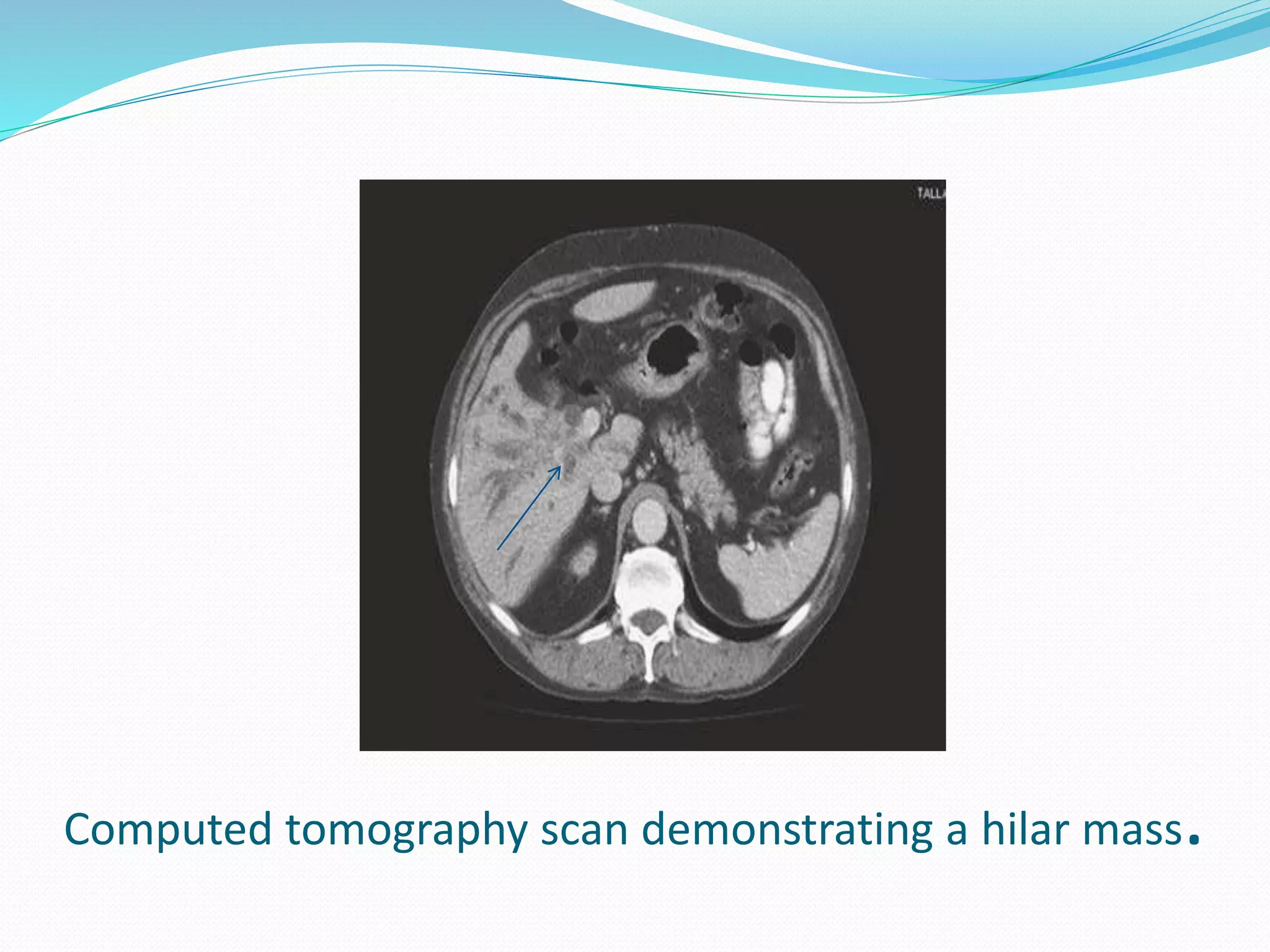 Computed tomography scan demonstrating a hilar mass.
 