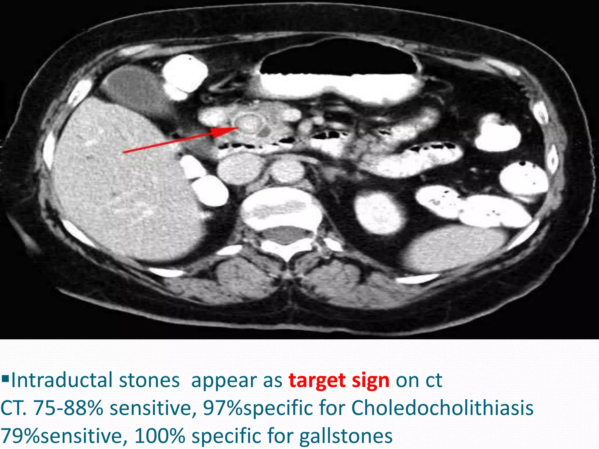 Intraductal stones appear as target sign on ct
CT. 75-88% sensitive, 97%specific for Choledocholithiasis
79%sensitive, 100% specific for gallstones
 