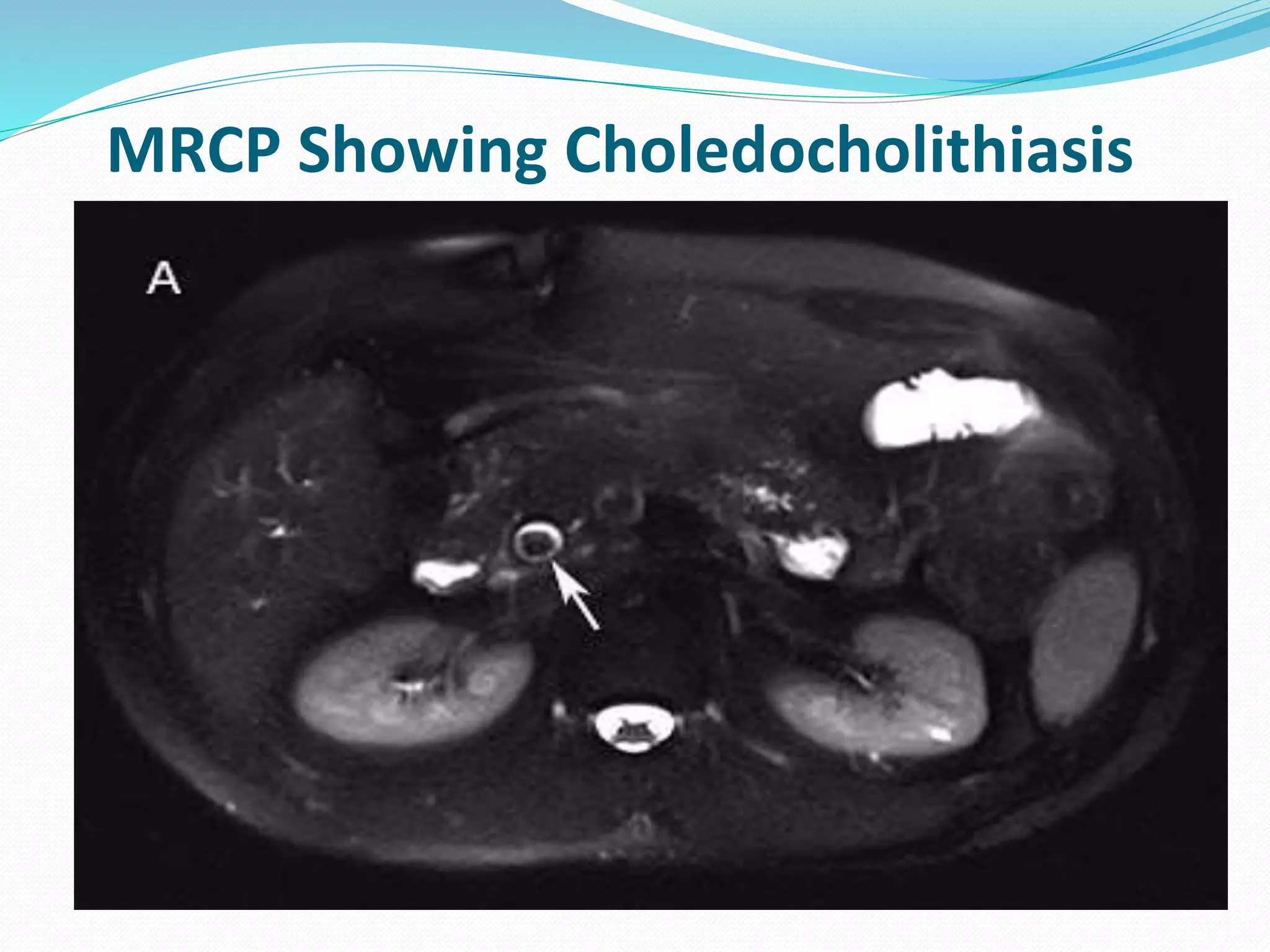 MRCP Showing Choledocholithiasis
 