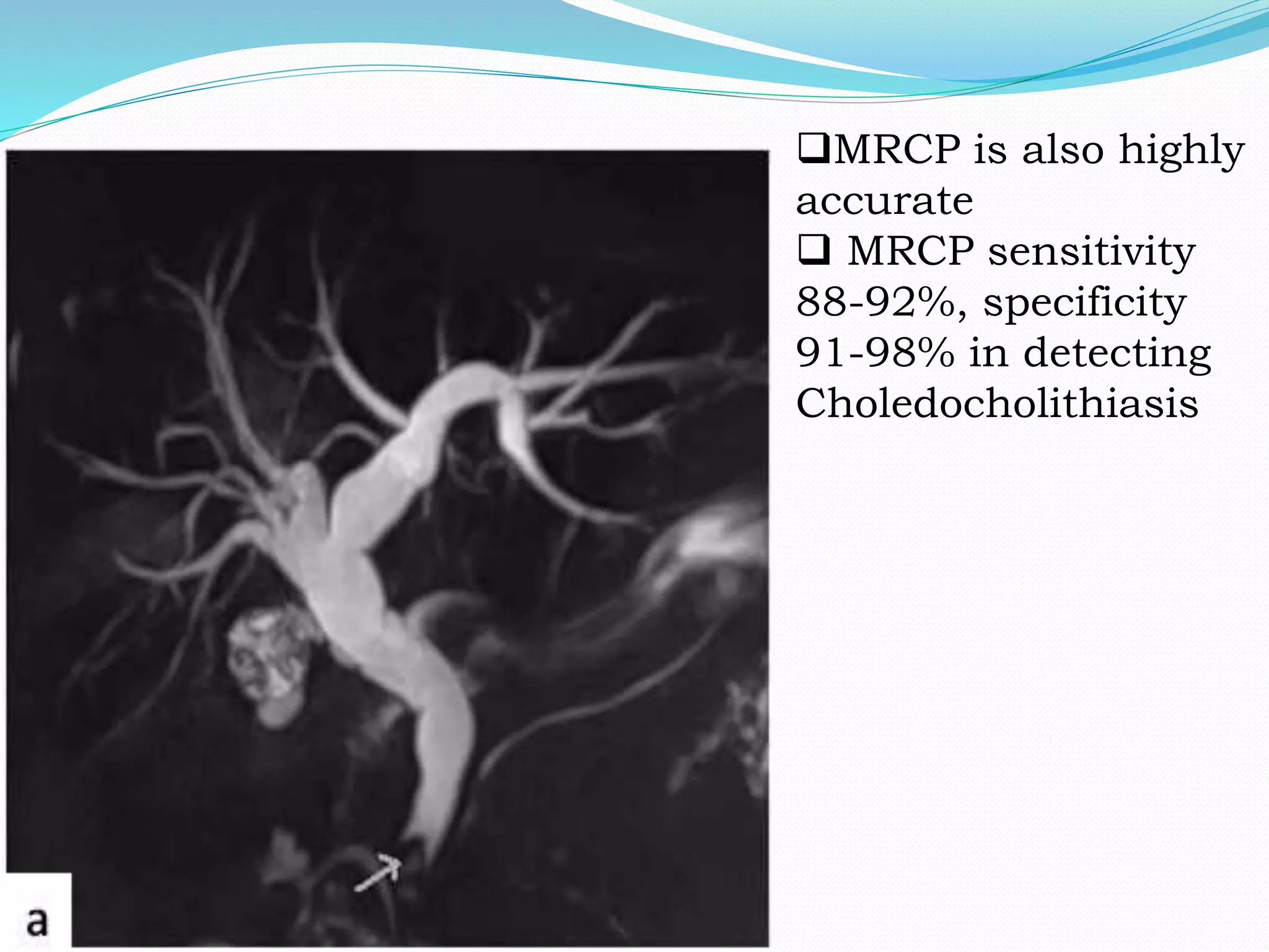 MRCP is also highly
accurate
 MRCP sensitivity
88-92%, specificity
91-98% in detecting
Choledocholithiasis
 