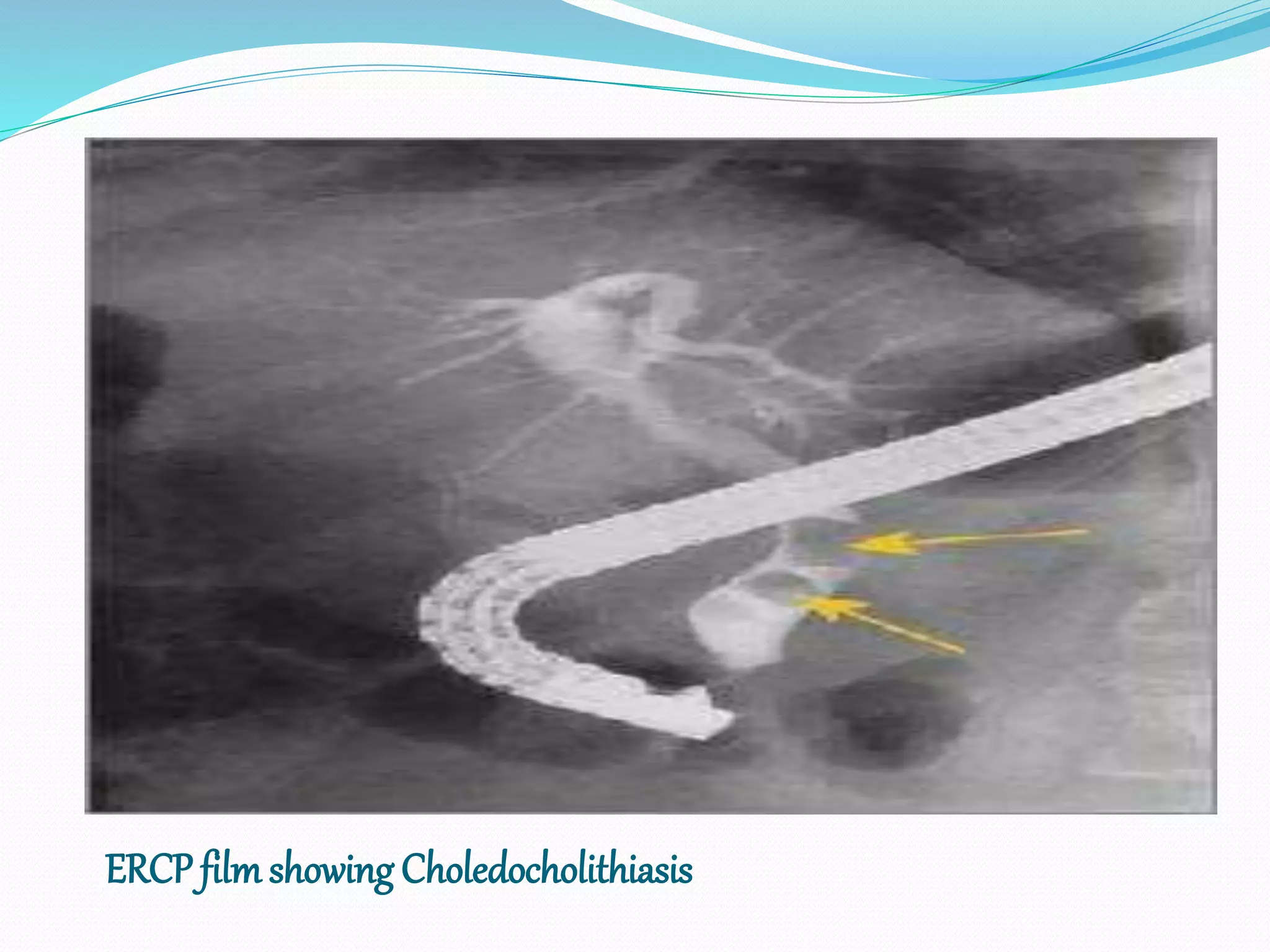 ERCP film showing Choledocholithiasis
 