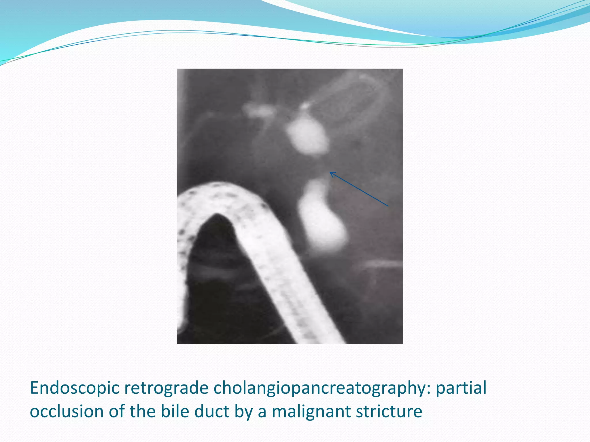 Endoscopic retrograde cholangiopancreatography: partial
occlusion of the bile duct by a malignant stricture
 