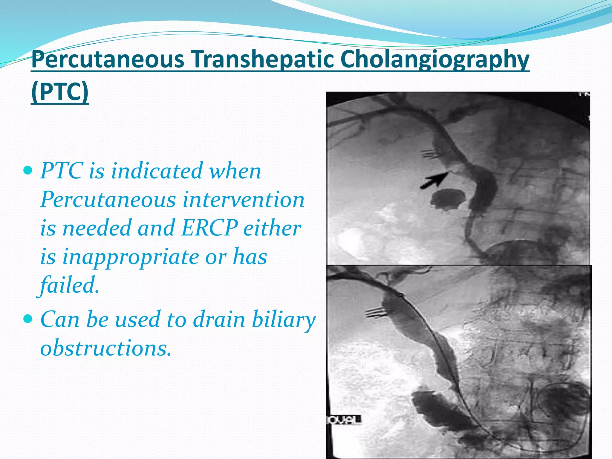 Percutaneous Transhepatic Cholangiography
(PTC)
 PTC is indicated when
Percutaneous intervention
is needed and ERCP either
is inappropriate or has
failed.
 Can be used to drain biliary
obstructions.
 