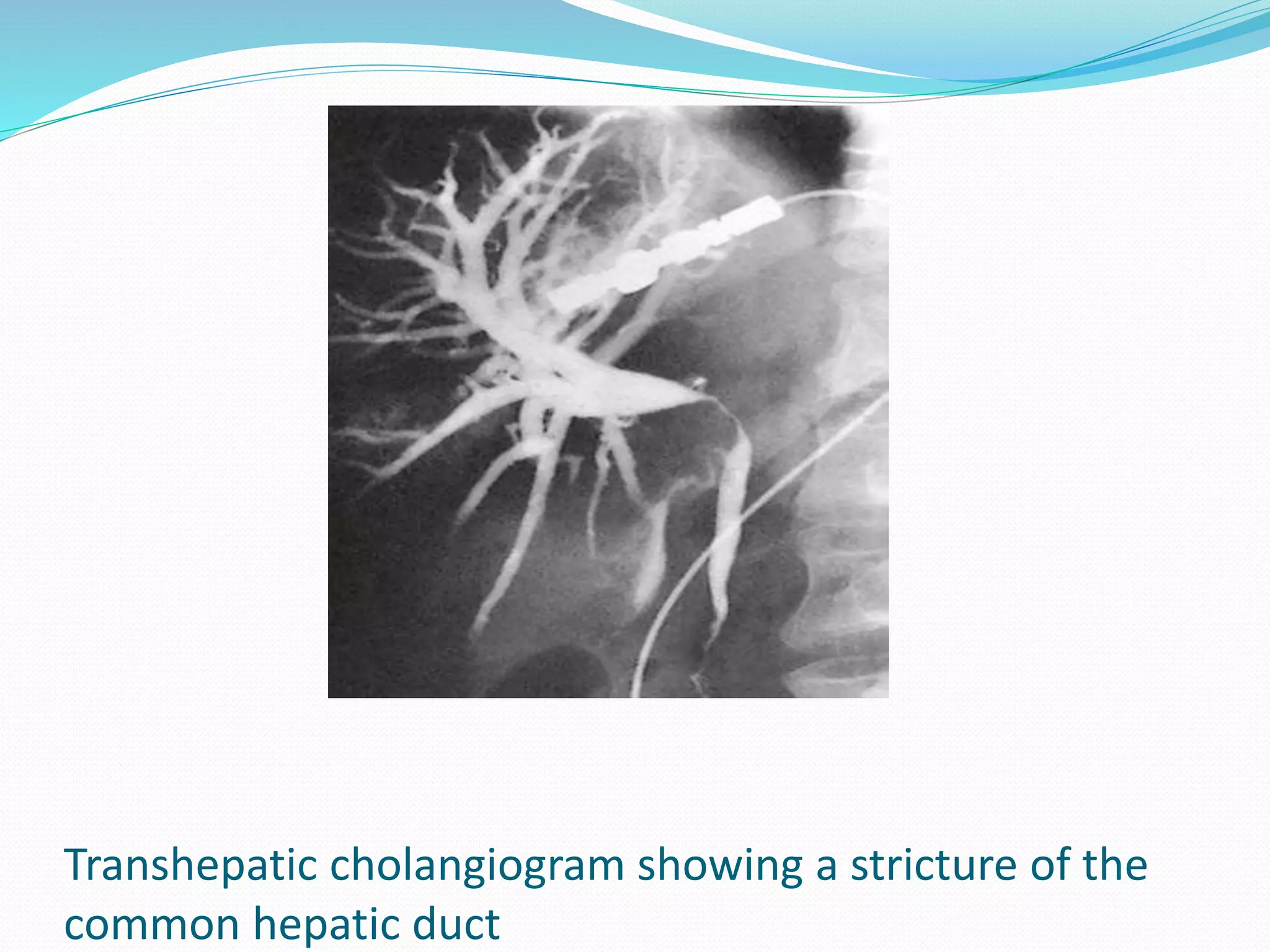 Transhepatic cholangiogram showing a stricture of the
common hepatic duct
 