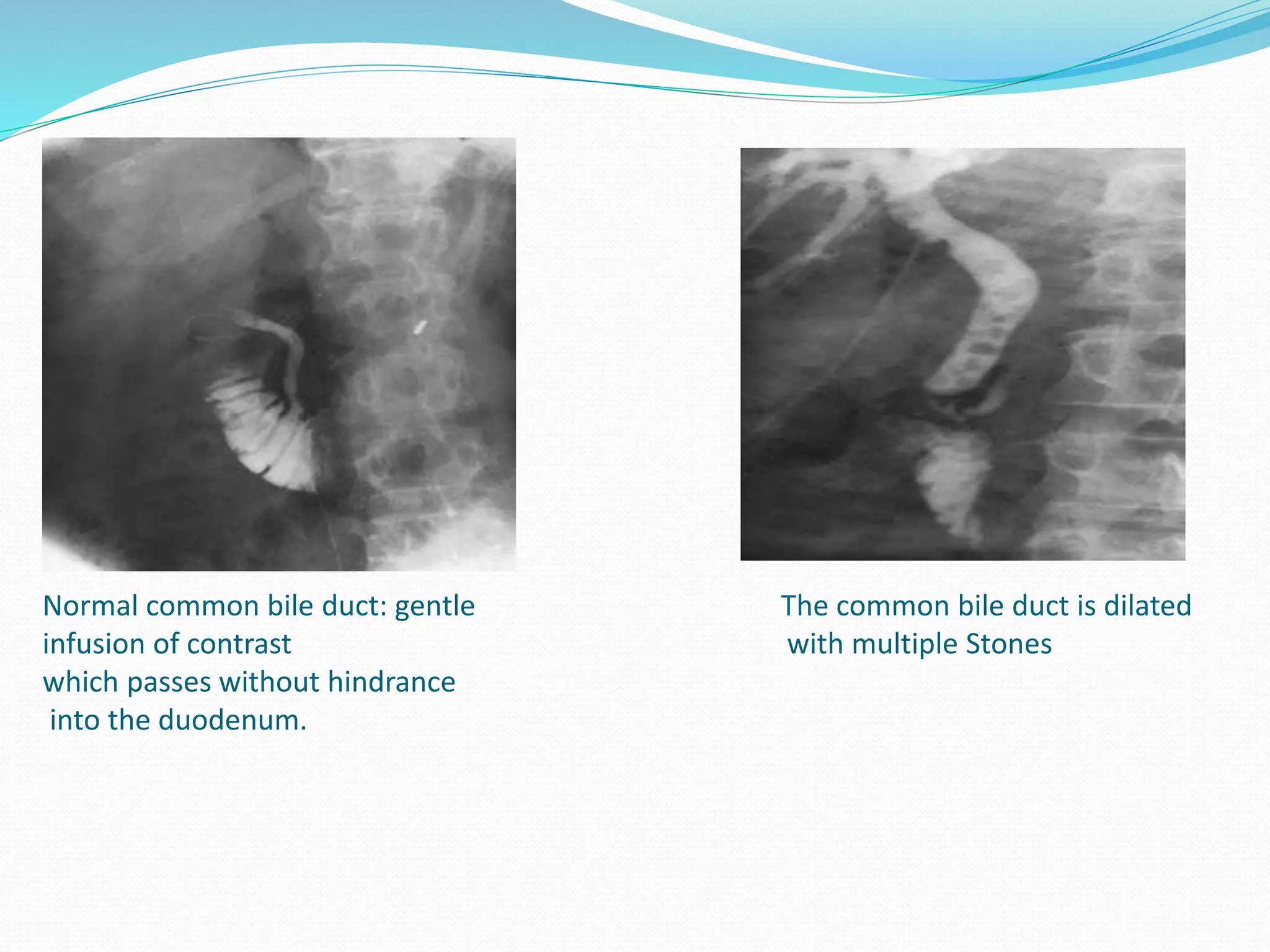 Normal common bile duct: gentle The common bile duct is dilated
infusion of contrast with multiple Stones
which passes without hindrance
into the duodenum.
 
